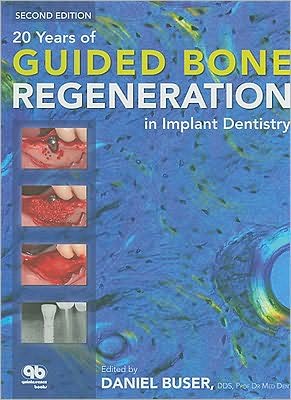 20 Years of Guided Bone Regeneration in Implant Dentistry