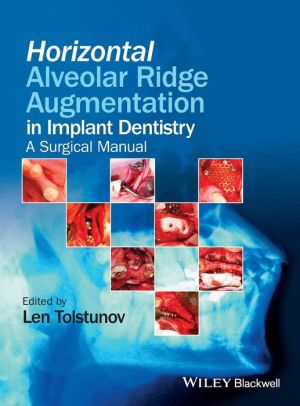 Horizontal Alveolar Ridge Augmentation in Implant Dentistry: A Surgical Manual