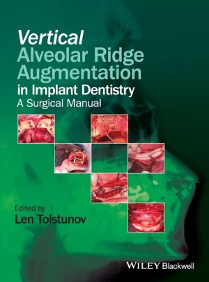 Vertical Augmentation of the Alveolar Ridge in Implant Dentistry